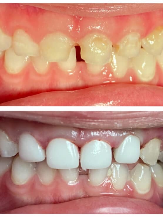Before and After Children's Full Mouth Reconstruction - Doan & Lee Pediatric Dentistry Tracy, CA